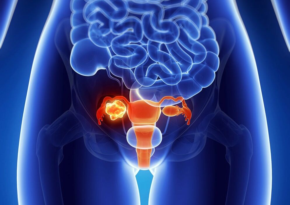 Eggs of the woman's ovarian pathology under the influence of alcohol